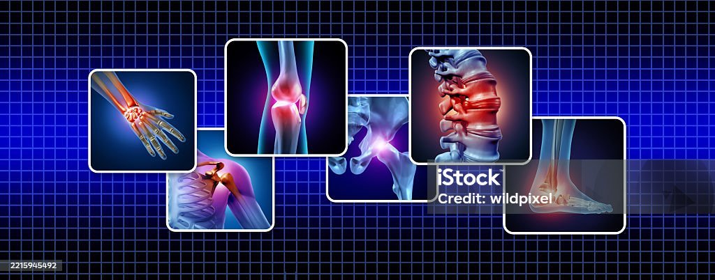 Chronic Joint Pain
